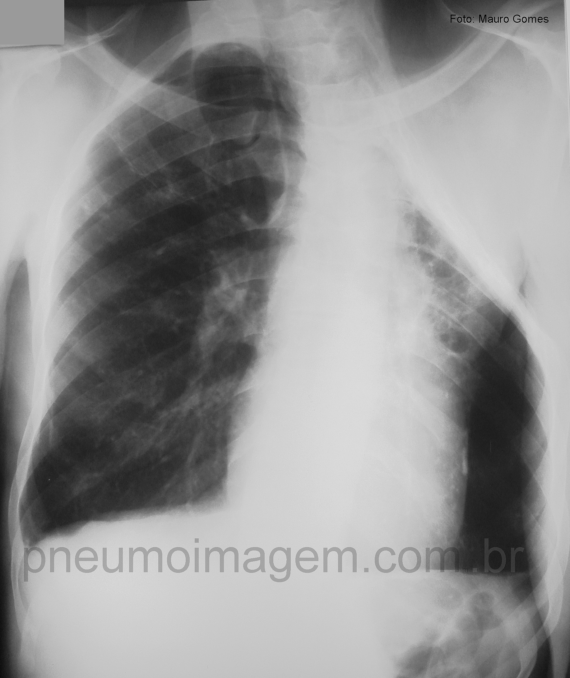 TRATAMENTO CIRÚRGICO NA TUBERCULOSE MULTIRRESISTENTE TRATAMENTO CIRÚRGICO NA TUBERCULOSE MULTIRRESISTENTE